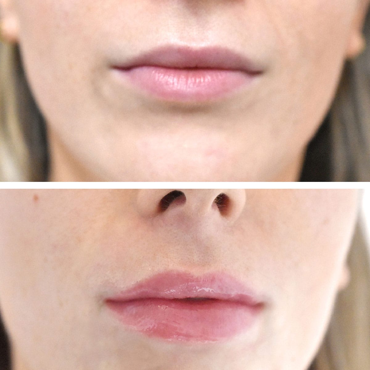 London Lip Clinic — photo 4