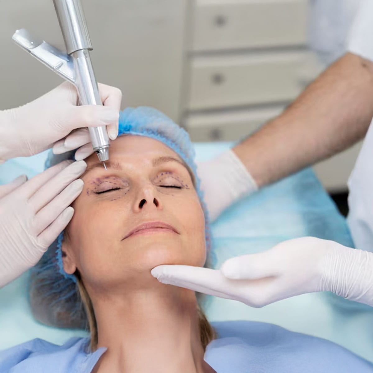 Thread Lift, Marylebone Clinics, PDO Threads